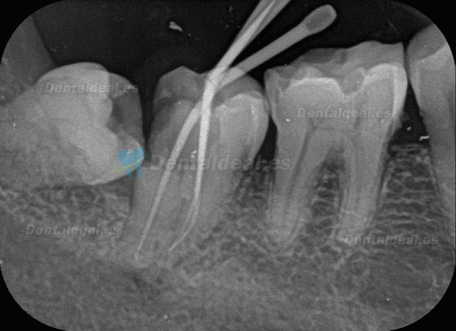 Fussen F200 Dental Phosphor Plate Scanner PSP X ray Scanner